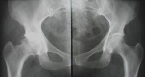 Артриты и артрозы