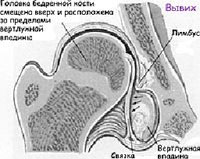 Анатомические особенности тазобедренного сустава при дисплазии