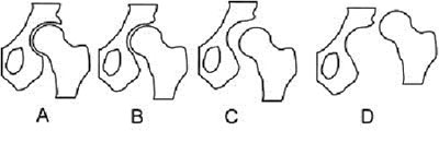 Классификация дисплазии тазобедренного сустава