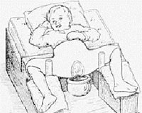 Вправление вывиха и лечение кокситной повязкой