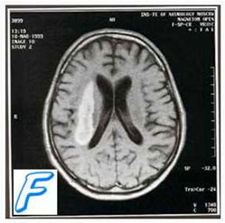Геморрагический инсульт