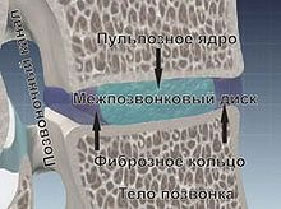 Межпозвонковая грыжа